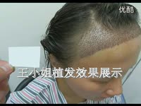 热推 西安哪里<em>可以植头发</em>-碧莲盛_17173游戏视